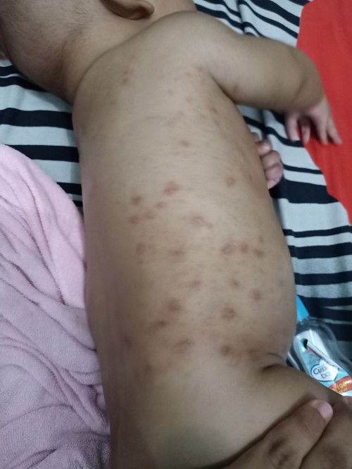 Help obat gatal bayi