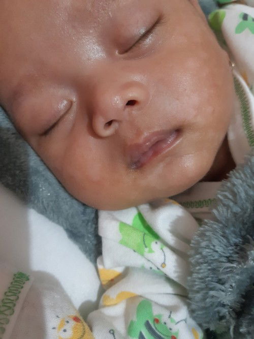 Bercak putih di muka bayi