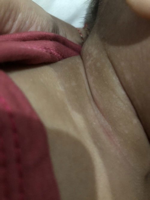 Bercak putih di leher bayi