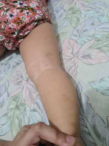 Mosquito bites