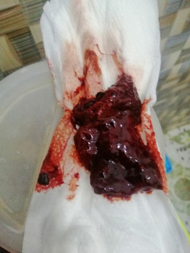 Postpartum hemorrhage