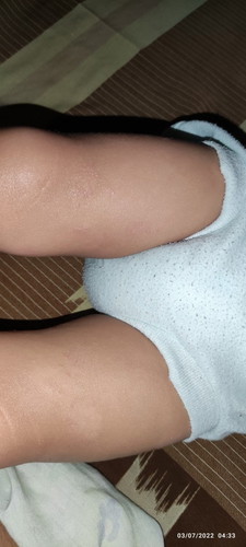 bun cara hilangin kulit kering bersisik gatal pada anak 18 bulan gimana ya