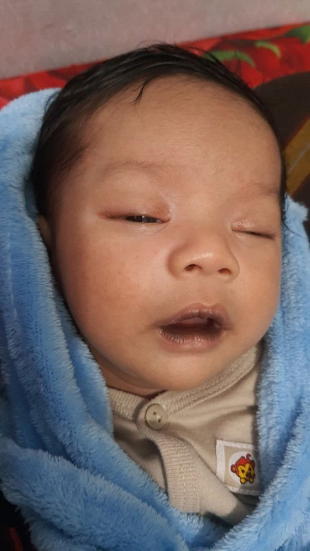 Bibir hitam pada bayi