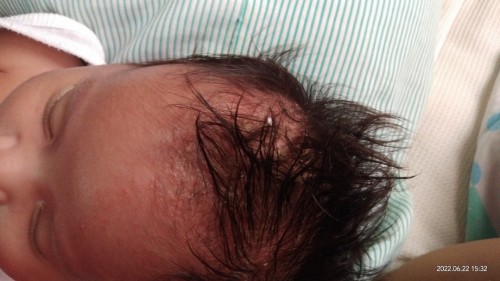 Cradle cap cleaning