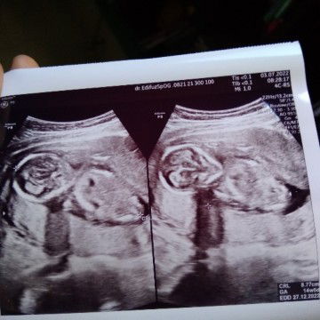 Hasil usg dan posisi janin