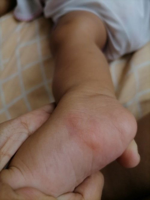 Red rash sa paa ni lo