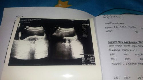 bun ini usg aku wktu pas 5week.apakah mungkin janin aku kembar yah. skrng udh 7week.