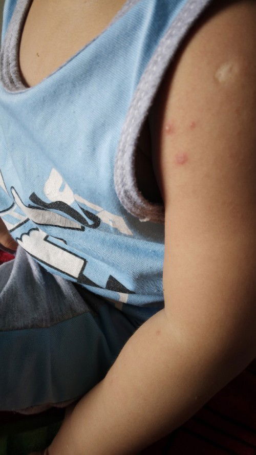 Cu Bơ nhà e 18 tháng tay bị nổi như vậy là sao ạ các mom?