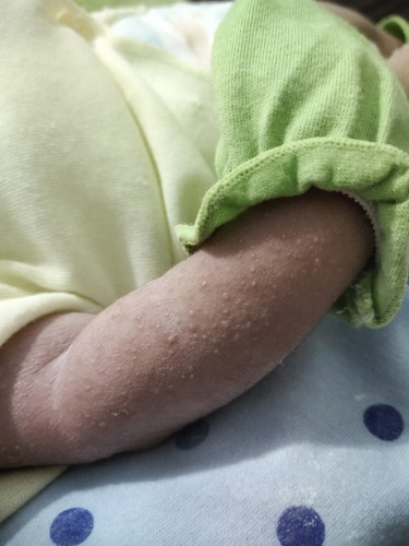 Bentol merah berair bayi umur 8 hari?
