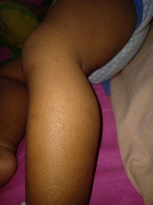 Alergi cara ngilangin yang ampuh pakai apa ya bun tolong udah saya kasih bedak herocyn baby powder