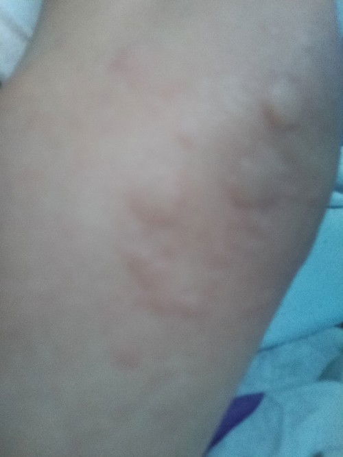 Bund... disini ada yang sama gak? Sehabis lahiran Biduran setiap hari, pagi, siang, sore, dan malam?