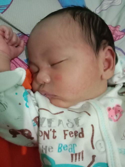 Bentol Merah baby newborn Kenapa ya?