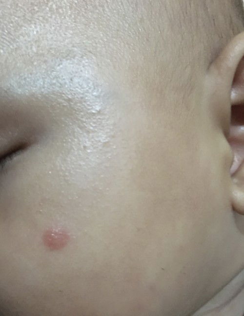 Bintik merah dikulit bayi