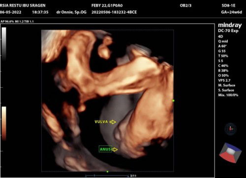 Apa ini jenis kelamin perempuan, menurut bunda ini bener ngga?