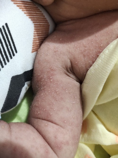 Cara mengatasi bintik merah berair pada bayi umur 9 hari?