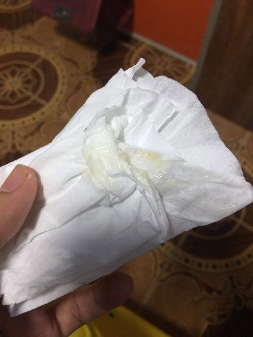 35+5วีค เราจะคลอดก่อนกำหนด หมอเลยไห้เเอดมิดฉีดยากระตุ้นปอดทารกในครรภ์