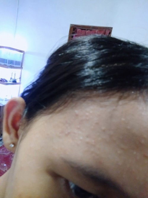 bruntusan saat hamil