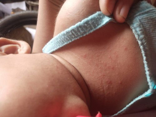 Tigdas po ba ito or rashes?