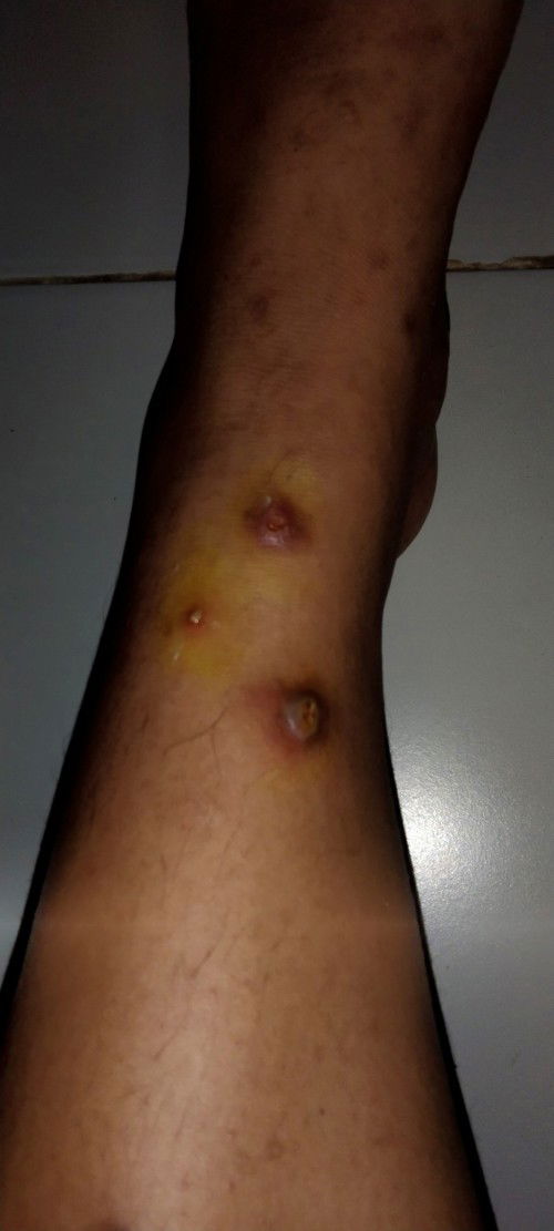 ตุ่มหนองแม่ตั้งครรภ์