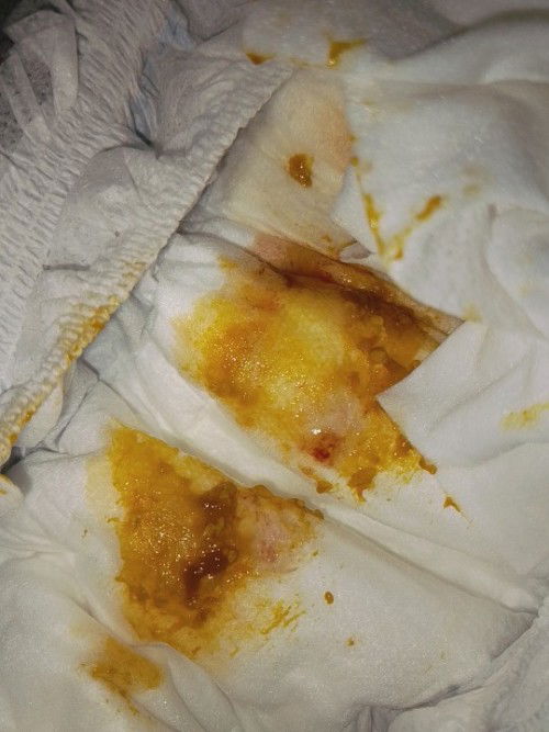 Hello po.. pasintabi po..ask ko lng po kung normal po ba yung ganto na kulay ng dumi ng baby .