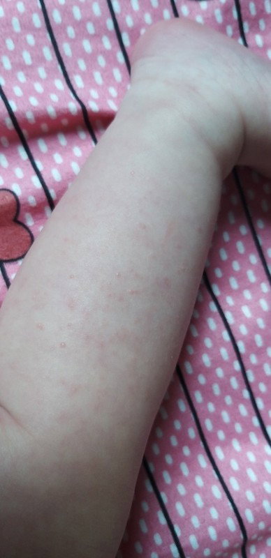 Da bé nổi đỏ