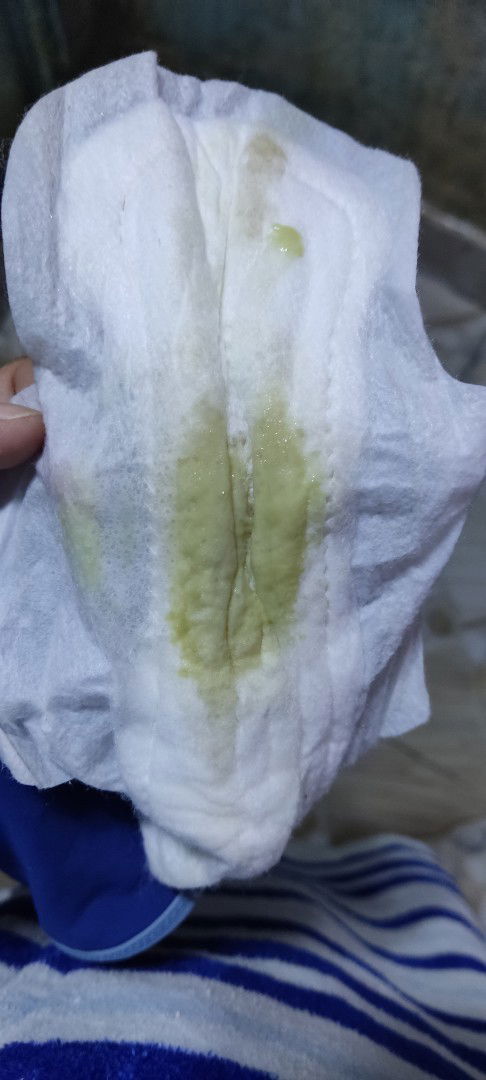 LOCHIA/AFTER GIVING BIRTH BLEEDING 1MON&2DAYS