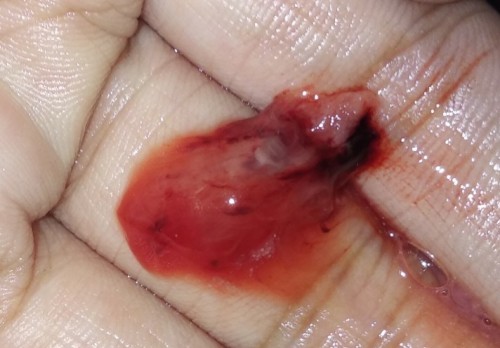 ask ko lang po kung miscarriage ba to o Hndi 😥 1 month delay po at 3 PT positive.
Kahapon Lang to