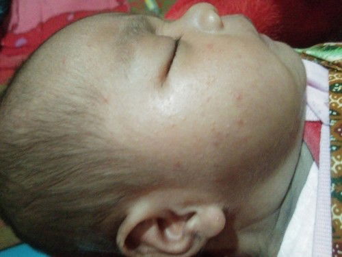 bentol krmerah merahann