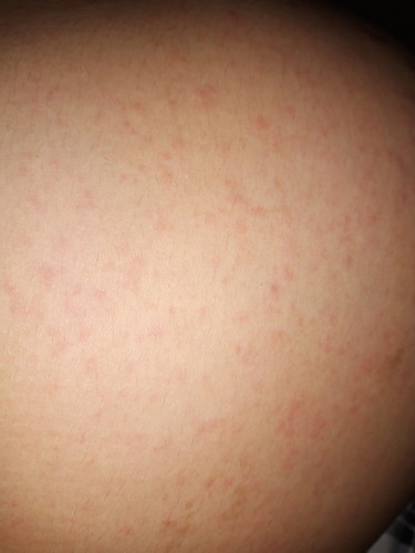 37 weeks stomach rashes