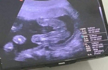 ฝากแม่ๆช่วยดูเพศน้องหน่อยค่ะ 20w.