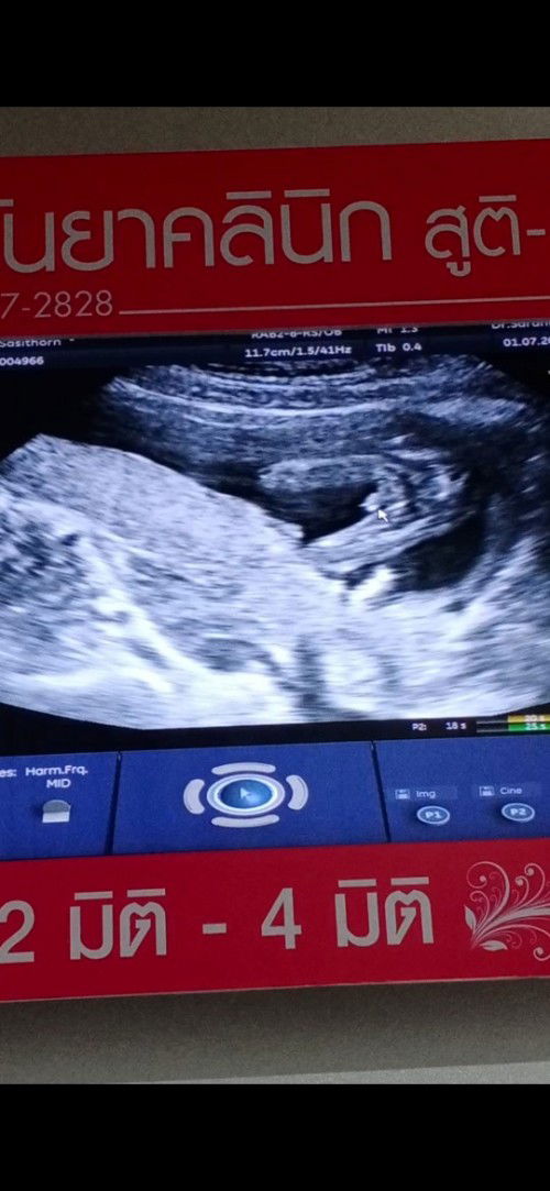 เราไปซาวมาค่ะ ตอน16+5 เหนเพศน้อง หมอบอกชาย เราอยากถามว่า ทำไมคนอื่นซาวใต้หว่างขาน้องเหนแค่จุ้ดจู๋โด่