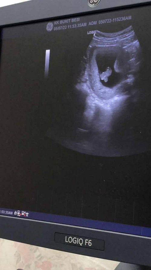 masa scan ada something disebalik baby