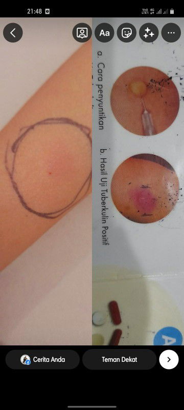 Pejuang Flek TB anak