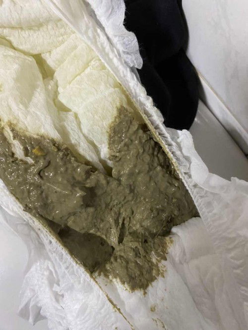 ลูกอึเป็นสีนี้ เป็นอะไรไหมคะ