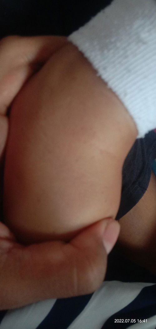 Penyebab Bercak merah di kulit bayi