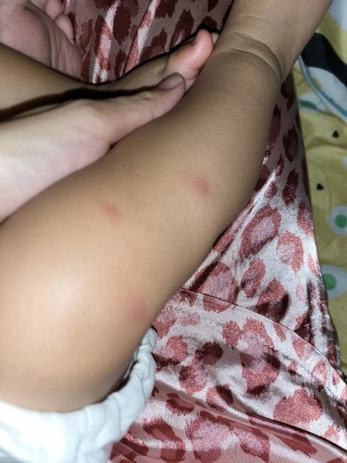 ลูกมีตุ่มแดงขึ้นเหมือนยุงกัด เกิดจากอะไรคะ มีไข้ด้วยค่ะ