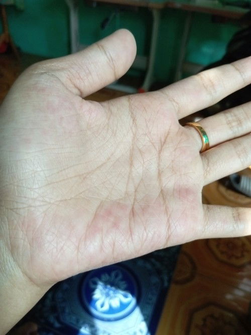 Bintik merah ditangan