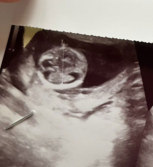 Hasil usg 15 week . Tanya hasil usg