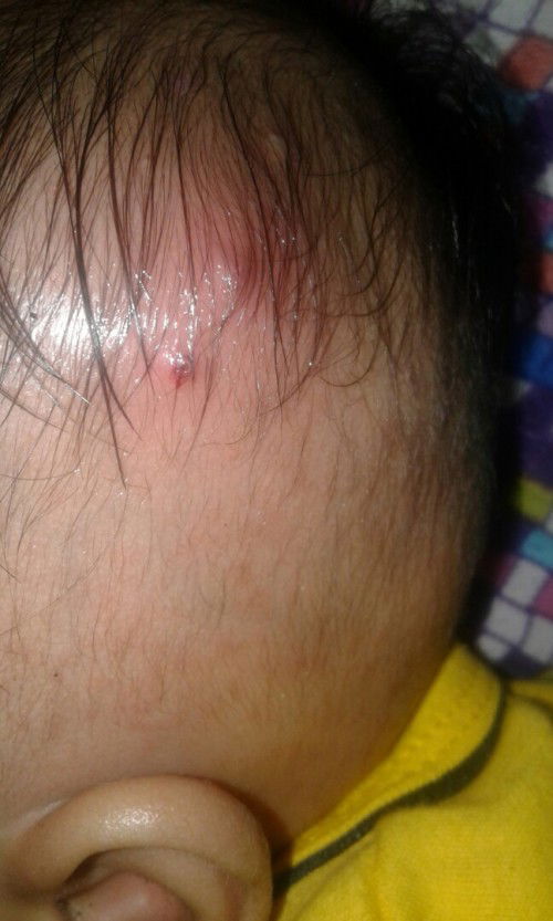 Benjolan di kepala bayi usia 5 bulan