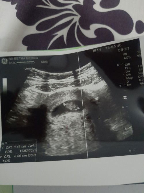 Bingung, kata dokter atau kata bidan