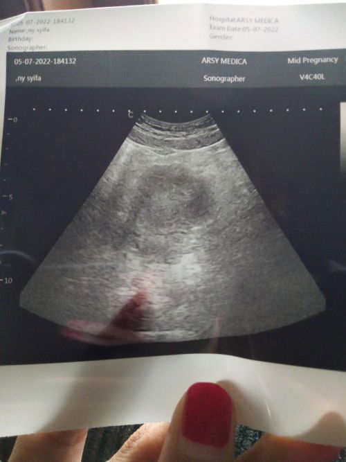 USG 5 Minggu masih belum terlihat