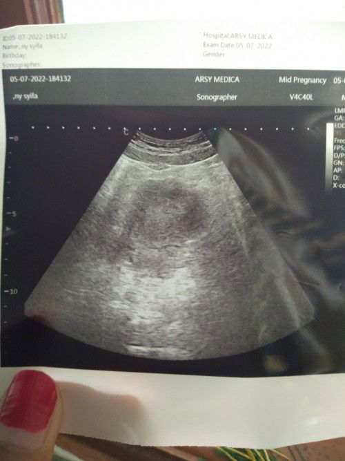 USG 5 Minggu tapi masih belum terlihat