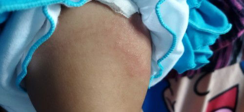 Campak apa keringat buntet?