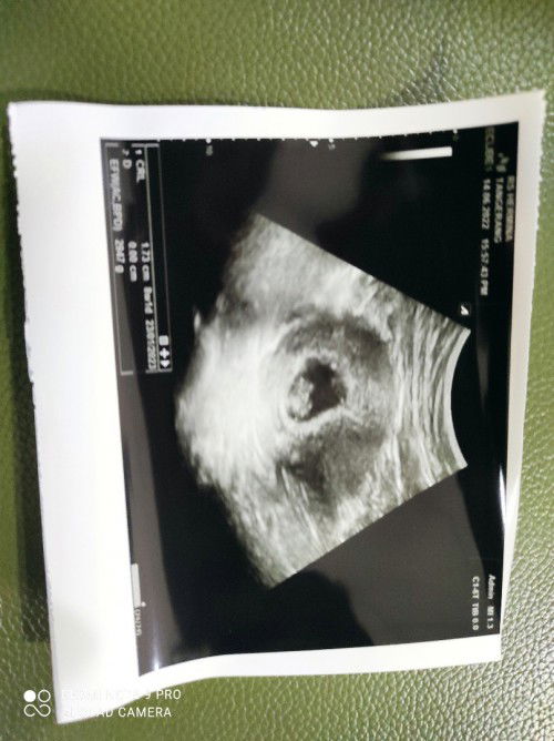 Hamil Pasca Keguguran tanpa Mens Dulu