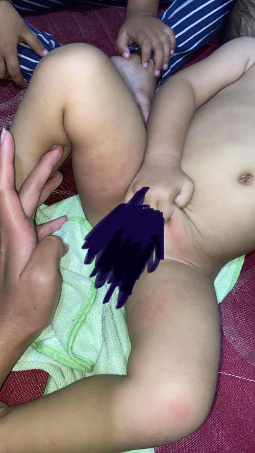 Merah pada selangkangan anak 14 bulan