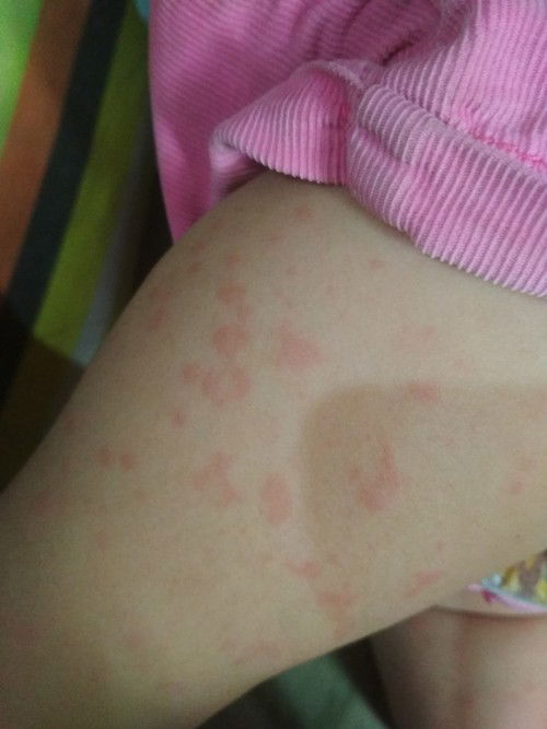 Ruam merah pada bayi usia 6 bulan