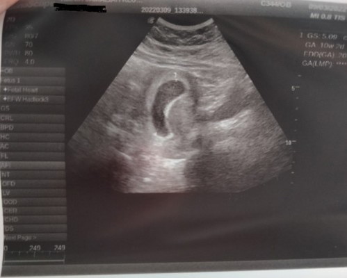 Pregnant 8 weeks