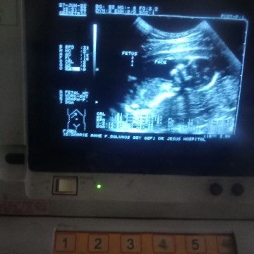 Baby Gender