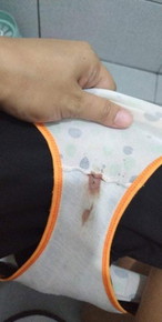 Bleeding after IE