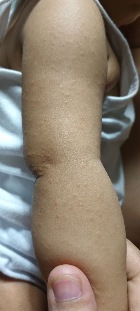 Mommies meron bang nka experience ng gnitong rashes sa babies nila? 1 week na d pa rin nwwala.